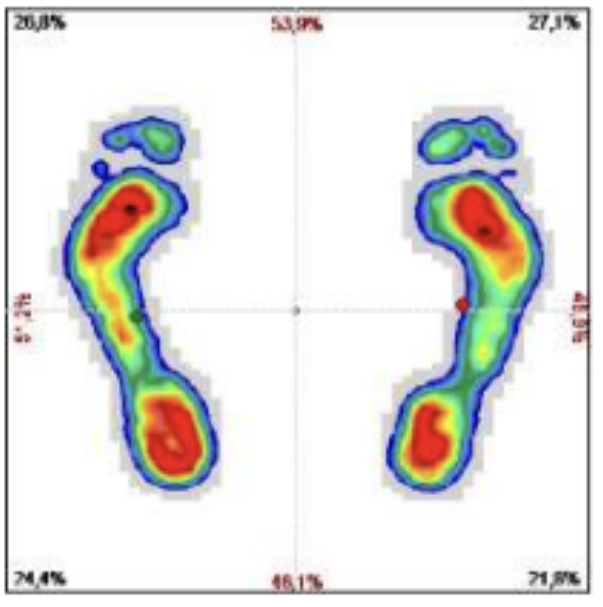 Carte thermique montrant les empreintes de pieds humains à gauche et à droite avec la pression la plus élevée (rouge) au niveau du talon, de la plante du pied et des orteils ; la pression la plus faible se trouve dans les zones bleues/vertes.
